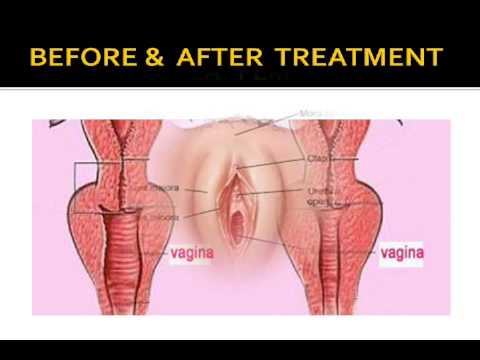 Before and after restults of kegel excersises